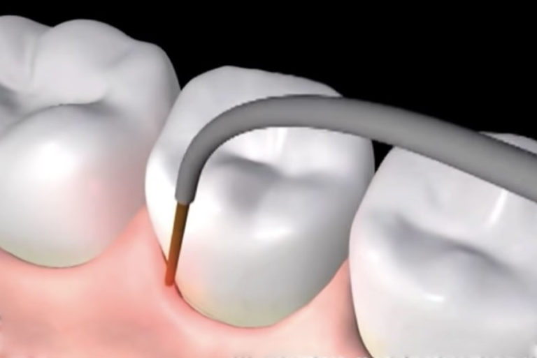 Laser Gum Surgery Baton Rouge, LA Barksdale Dentistry